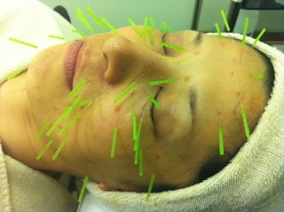 世界初の美顔鍼治療「オリエンタル美顔鍼」